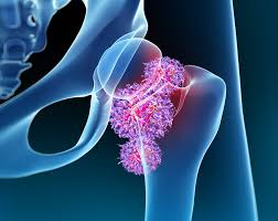 Spine surgery experts in Chennai